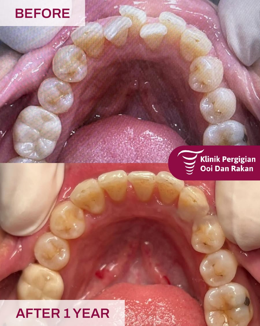 Before and after braces treatment at Ooi Dan Rakan