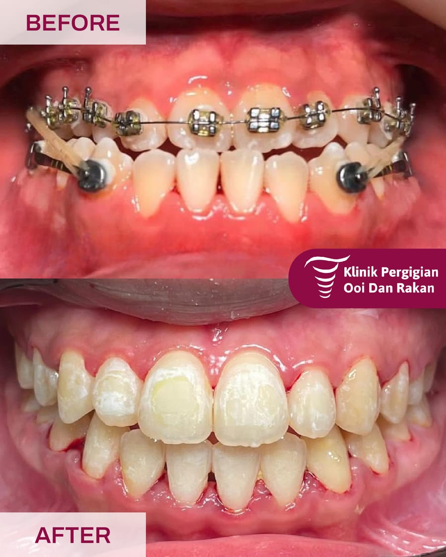 Before and after braces treatment at Ooi Dan Rakan, case 4