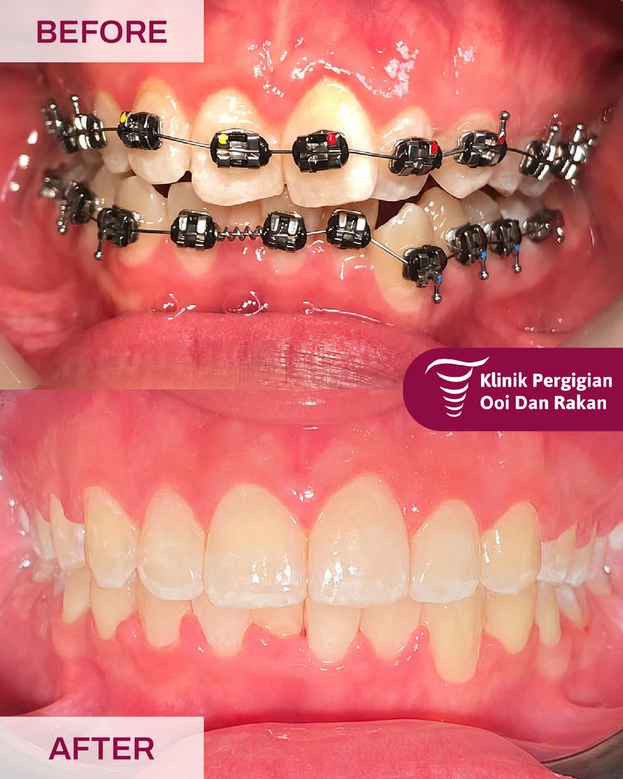 Before and after braces treatment at Ooi Dan Rakan