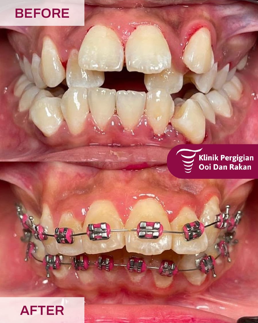 Before and after braces treatment at Ooi Dan Rakan, case 8