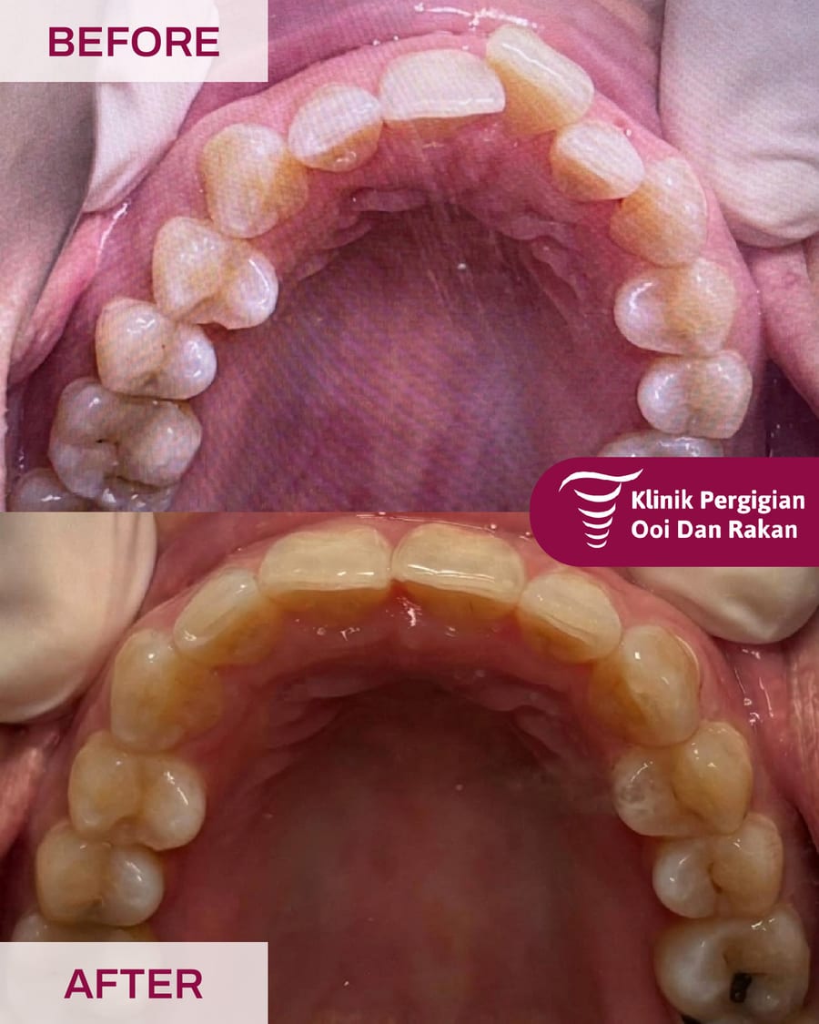 Before and after braces treatment at Ooi Dan Rakan, case 9