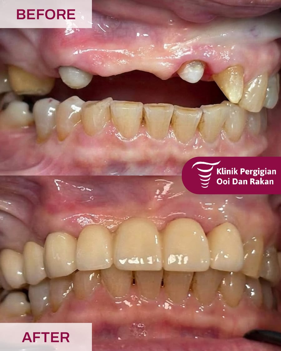 Before and after crowns and bridges treatment at Ooi Dan Rakan