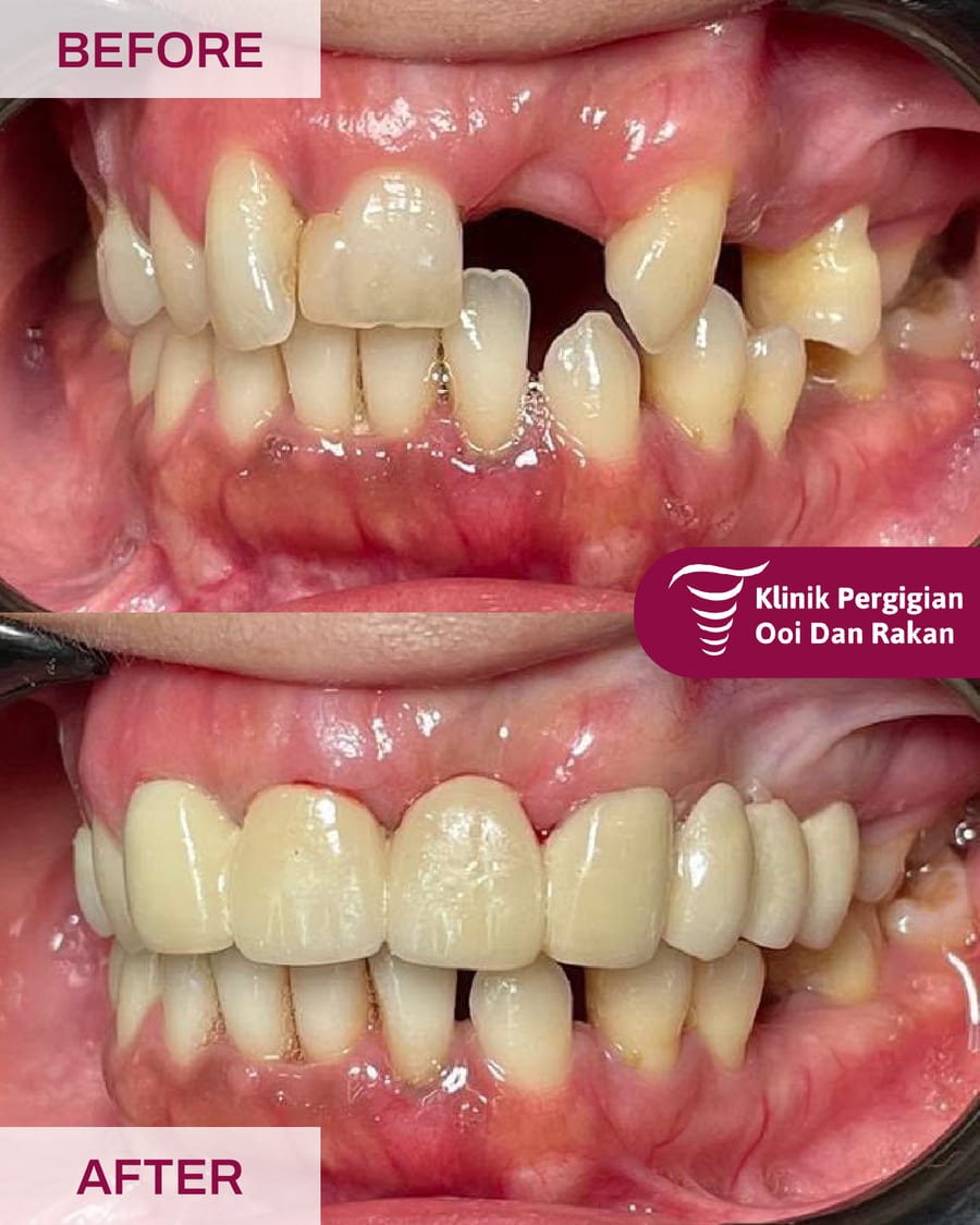 Before and after crowns and bridges treatment at Ooi Dan Rakan, case 3