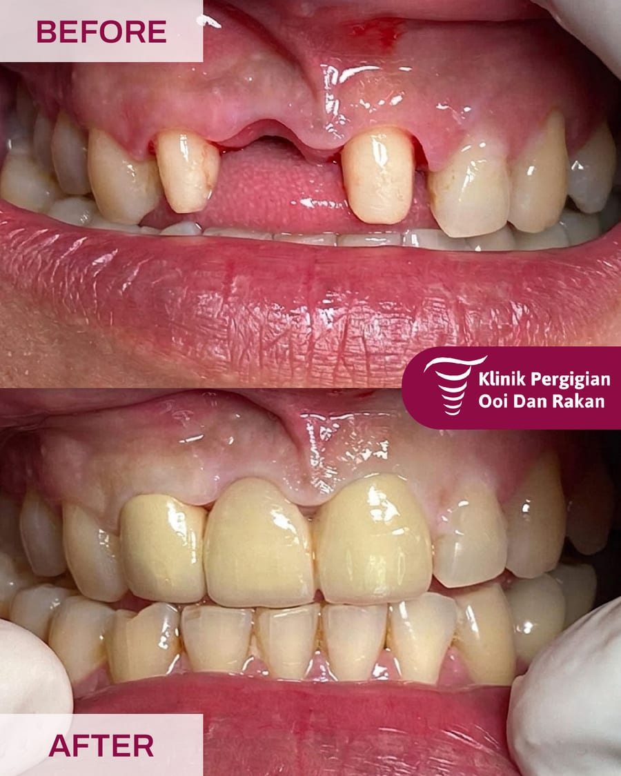 Before and after crowns and bridges treatment at Ooi Dan Rakan, case 6