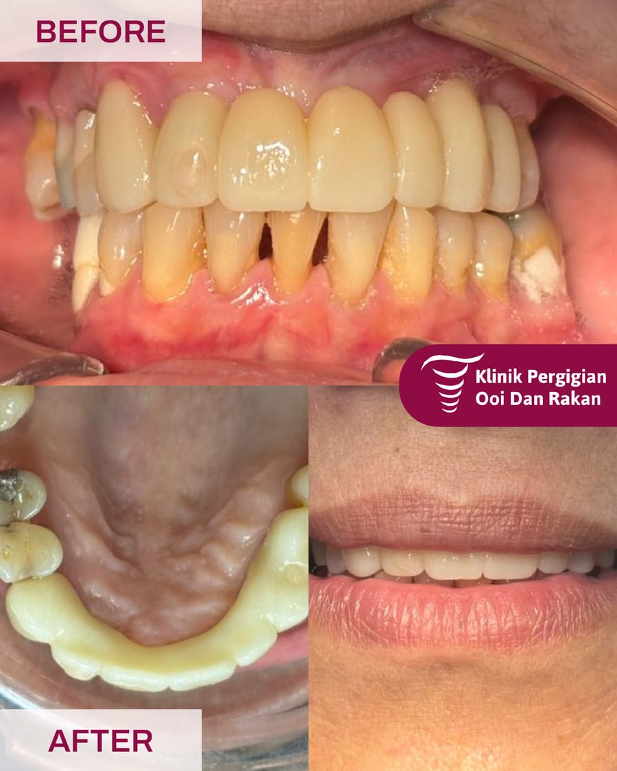 Before and after crowns and bridges treatment at Ooi Dan Rakan, case 9