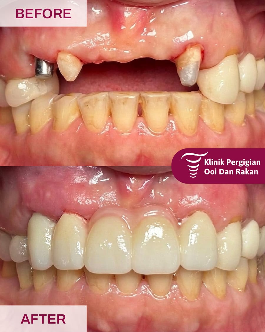 Before and after dental implant treatment at Ooi Dan Rakan