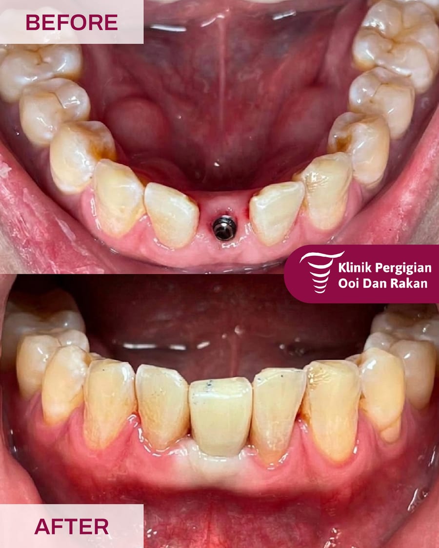 Before and after dental implant treatment at Ooi Dan Rakan, case 2