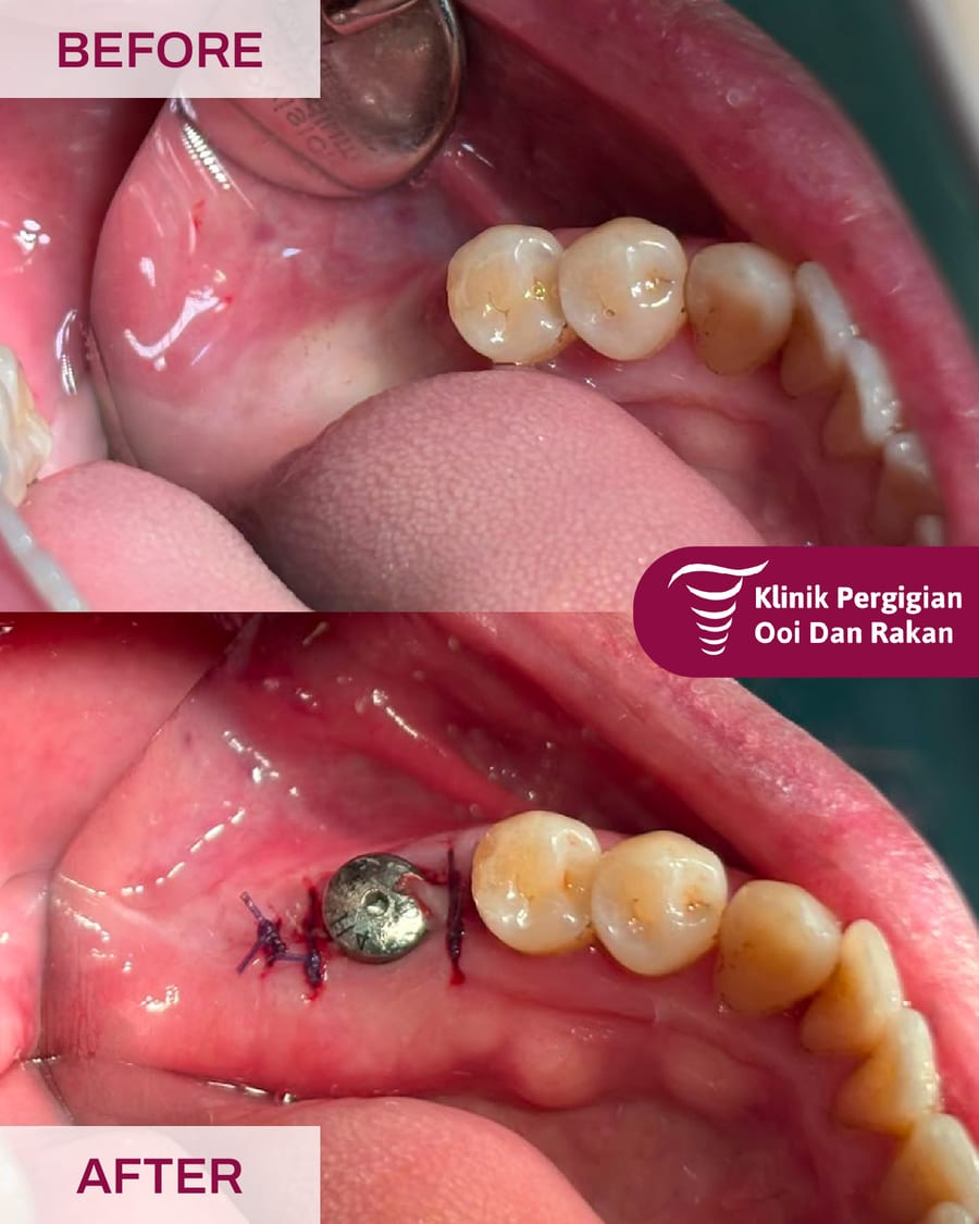 Before and after dental implant treatment at Ooi Dan Rakan, case 5
