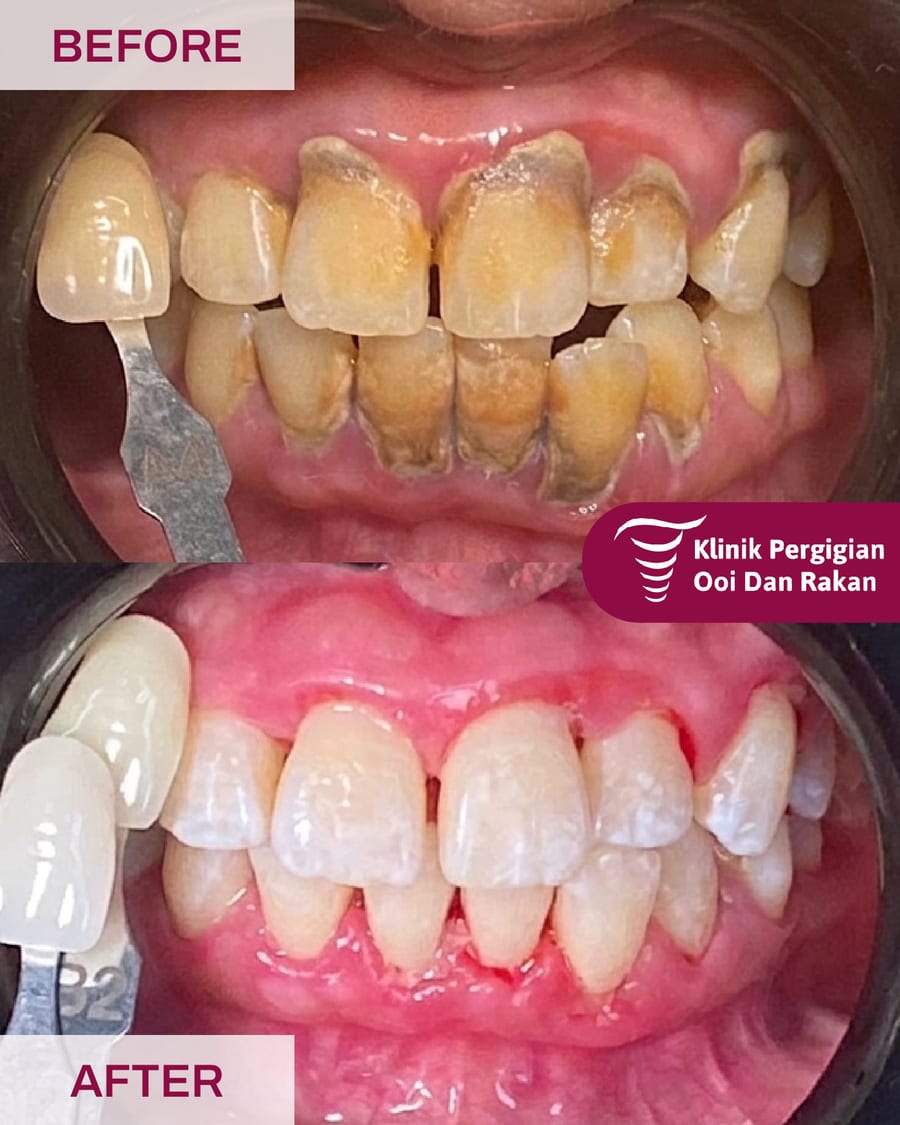 Before and after scaling and polishing at Ooi Dan Rakan, case 3