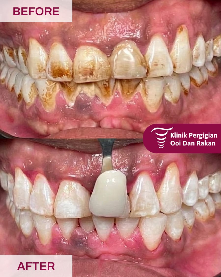 Before and after scaling and polishing at Ooi Dan Rakan, case 4