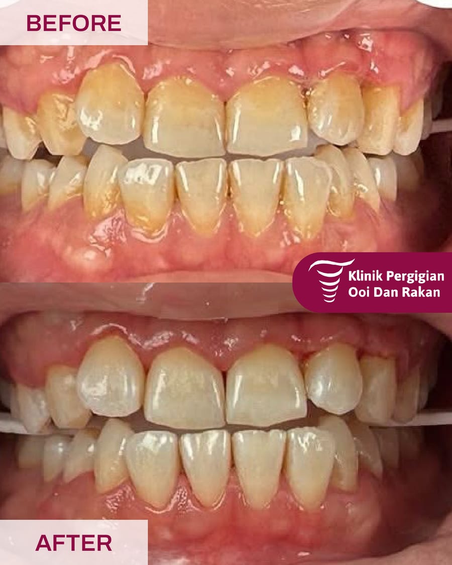 Before and after teeth whitening at Ooi Dan Rakan, case 1