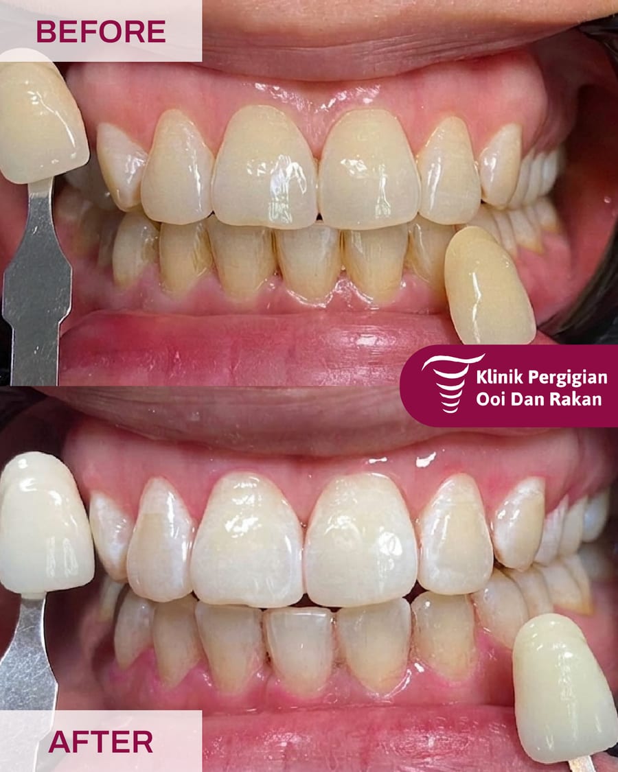 Before and after teeth whitening at Ooi Dan Rakan, case 12
