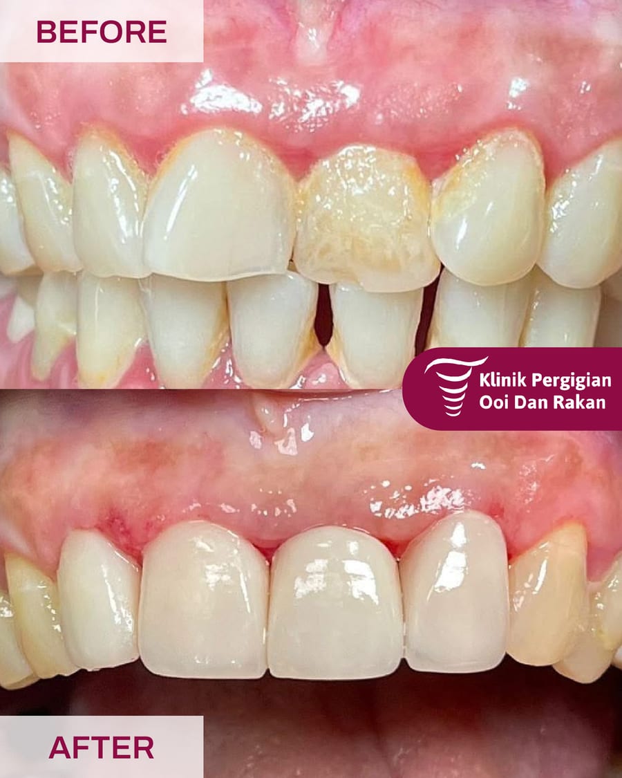 Before and after veneers at Ooi Dan Rakan, case 2