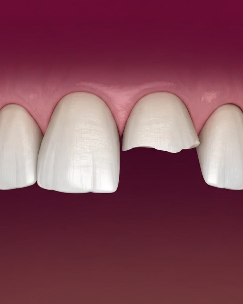 Broken Tooth Repair
