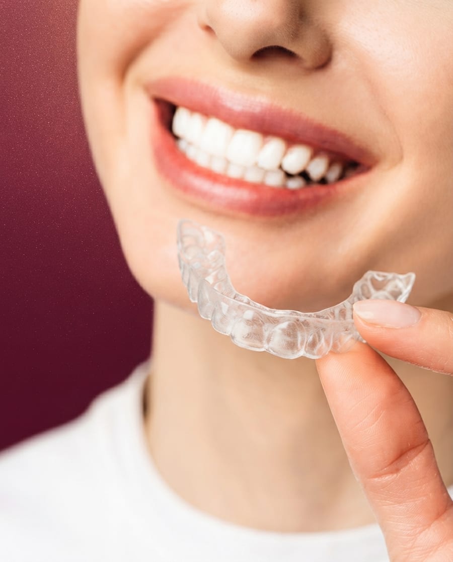Clear Aligners