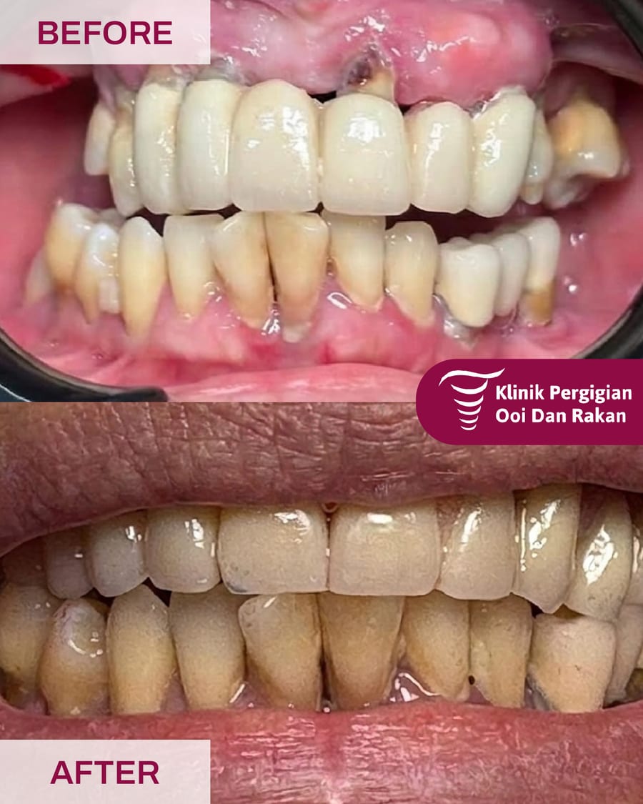 Full Mouth Restoration