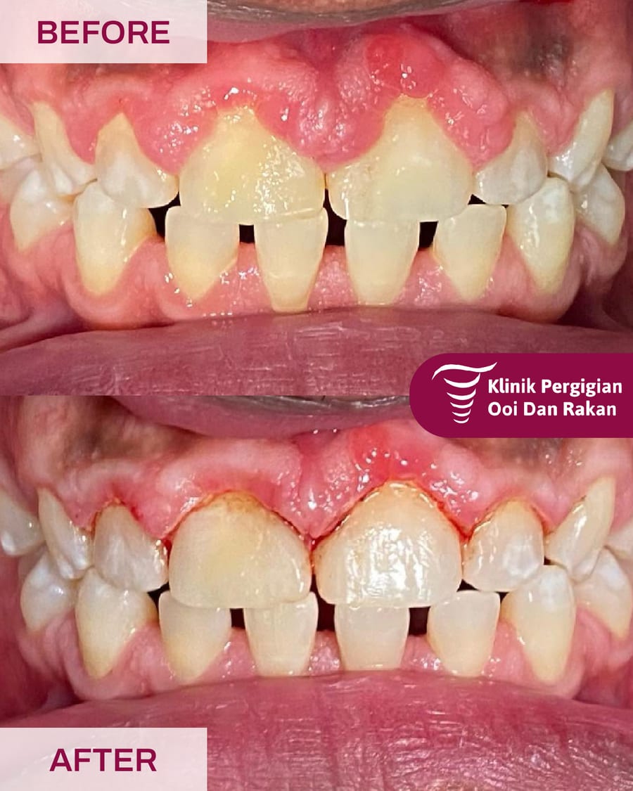Before and after example of gum contouring at Ooi Dan Rakan