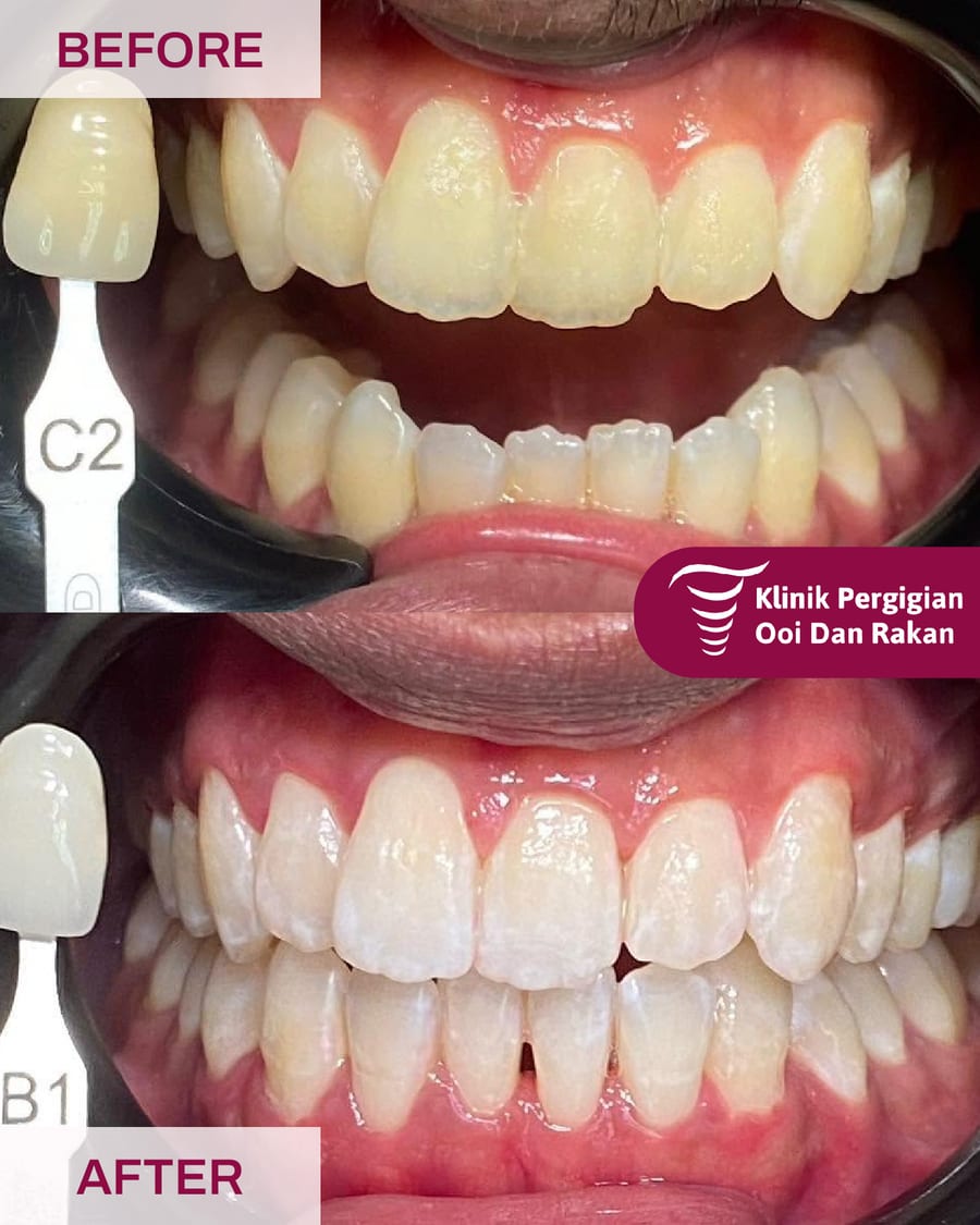 Teeth Whitening
