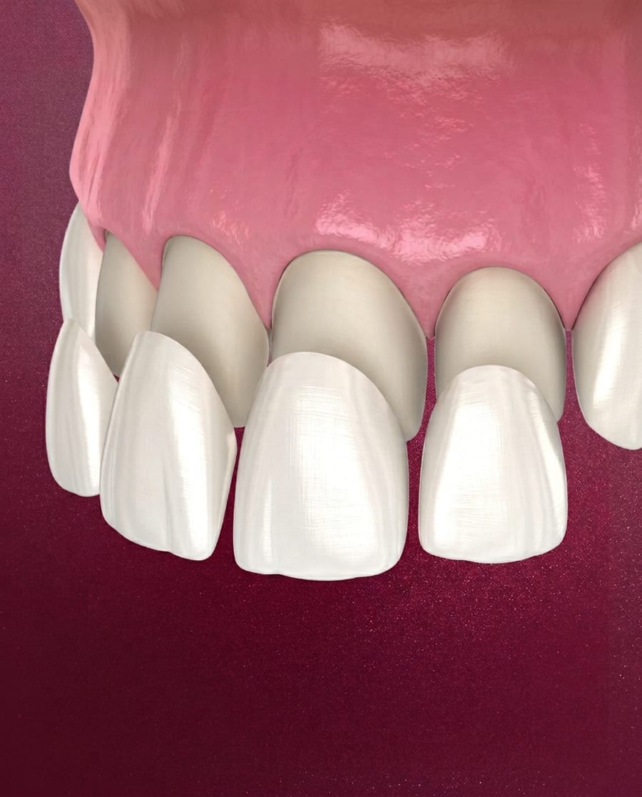 Veneers